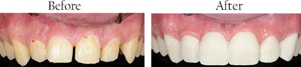 Before and After Dental Bonding near Bellingham