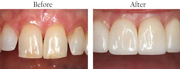 Bellingham Before and After Dental Cleaning